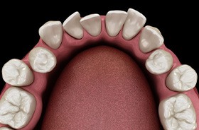 Illustration of crowded teeth viewed from above