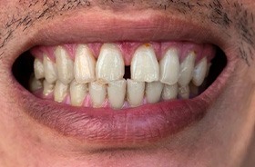 Man’s smile with a gap between the front teeth