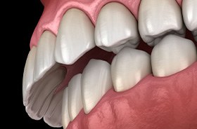 Illustration of an overbite against dark background