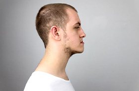 Side-view of young man with an underbite