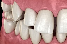 Close-up illustration of a crossbite