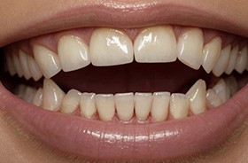 Close-up photo of person’s smile with an open bite