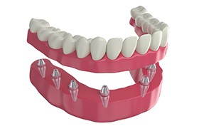 Illustration of implant denture for lower dental arch