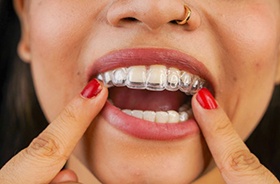 Close-up of woman’s mouth as she places clear aligner on her teeth