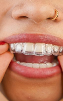 Woman putting in Invisalign