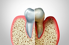 Illustration of healthy vs. diseased gums