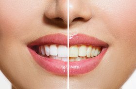 Close-up of woman’s smile before and after teeth whitening