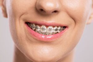 Close-up of person’s smile with traditional metal braces